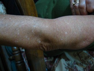 Mar�a Cristina mit rosa Hautflecken am
                          ganzen Arm