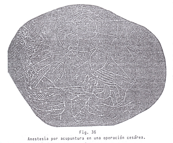 Fig. 36:
Anestesia con acupuntura en una
operación de cesárea Fig.
36: Anestesia con acupuntura en una
operación de cesárea