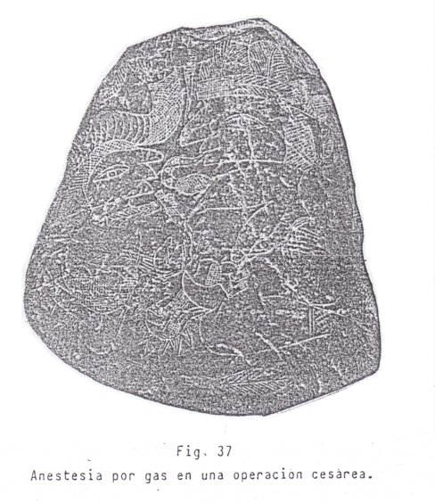 Fig. 37: Anestesia de gas en una
operación de cesárea Fig. 37: Anestesia
de gas en una operación de cesárea