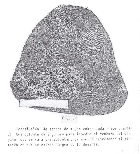 Fig.
                                38: Transfusi�n de sangre con mujer
                                embarazada