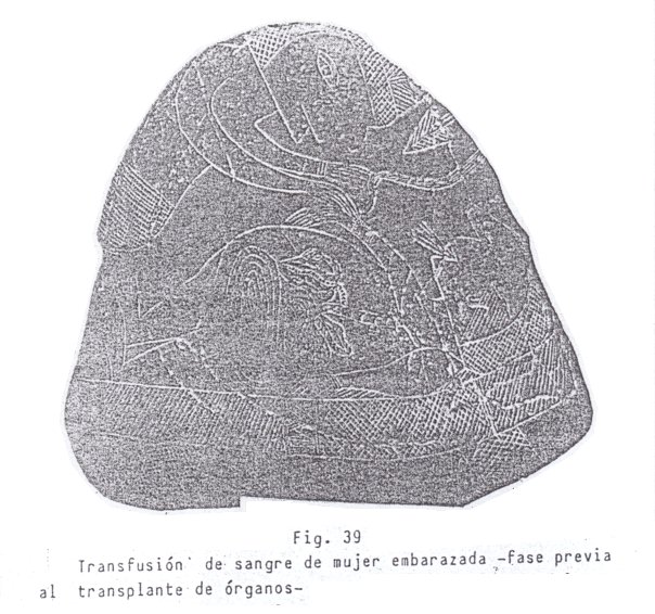 Fig. 39:
                                Transfusi�n de sangre con otra mujer
                                embarazada (02)