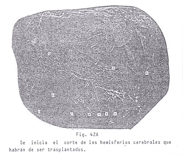 Fig.
                              42A: Cortes del cerebro