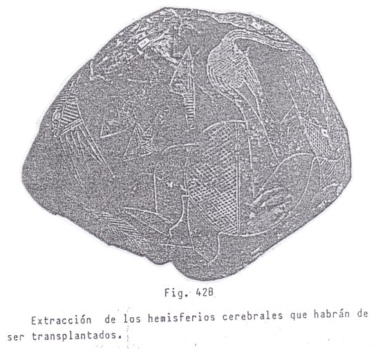 Fig.
                                42B: Extracci�n de los hemisferios
                                cerebrales que habr�n ser
                                transplantados