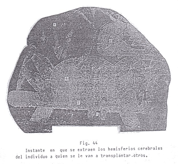 Fig.
                              44: Extracci�n de un cerebro
