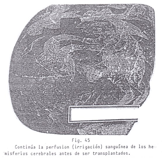 Fig. 45: Perfusi�n
                                de un cerebro