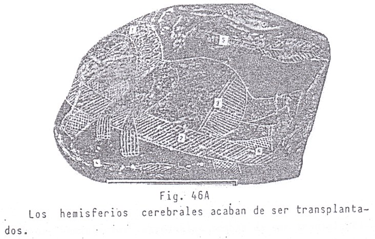 Fig.
                              46A: Fin de un transplante de un cerebro