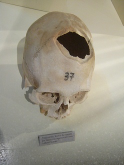 Aufgebohrter Sch�del 01