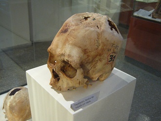 Aufgebohrter Sch�del 02