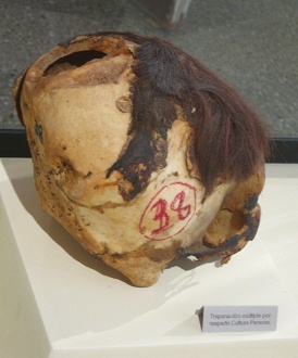 Mehrfach aufgebohrter Sch�del