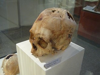 Drilled skull 02