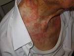 Pellagra durch
                                Vitamin-B-Mangel, rote Hautflecken